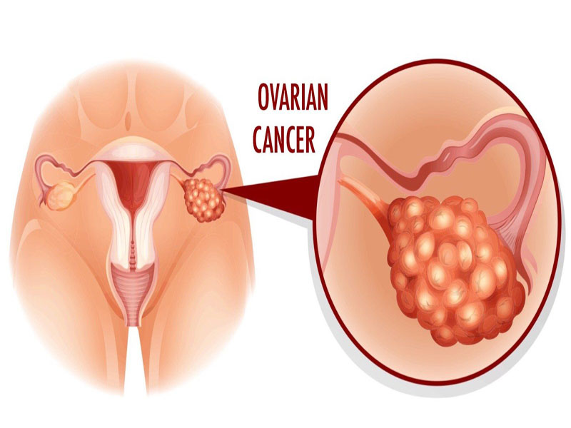 ওভারিয়ার বা ডিম্বাশয় ক্যান্সার
