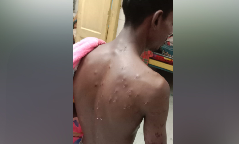 চুয়াডাঙ্গা সীমান্তে বিএসএফের ছররা গুলিতে যুবক আহত