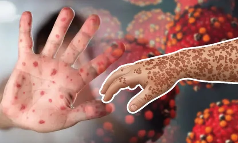 হামে ২৪ ঘণ্টায় আরও ১০ শিশুর মৃত্যু, আক্রান্ত ১৪২৮