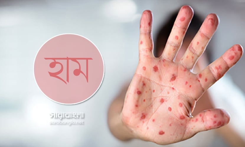 হাম উপসর্গে ৬ শিশুর মৃত্যু, নতুন আক্রান্ত ১৩১৬